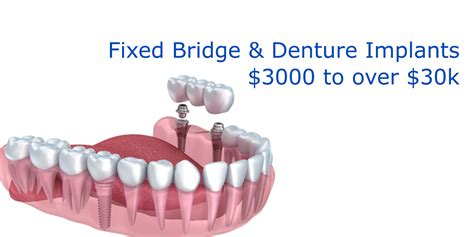 yuba city dental implants cost|Dental Implant Cost & Comparisons .